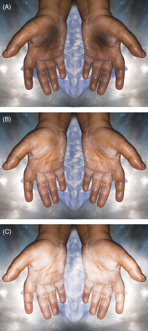 A 50 Years‐old Female With Hyperhidrosis Of Both Palms As Shown By The