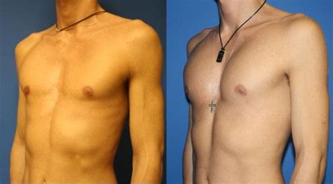 Know The Procedure Of Male Breast Reduction Break The Rules For A