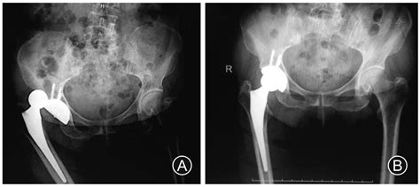 Mixed Bacterial Fungal Infection Following Total Hip Arthroplasty A