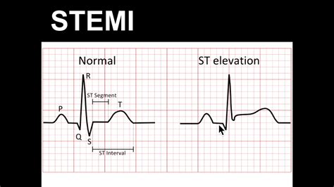 Hd Ecg Course St Elevation Part 1 Emrap