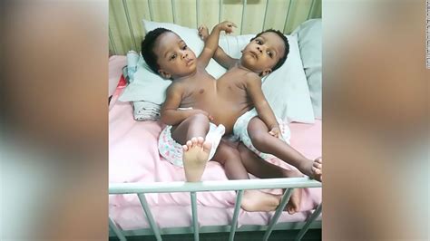 Nigerian Sisters Conjoined At The Chest And Abdomen Separated And Ready