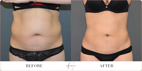 Female Tummy Liposuction Browse Before After Results
