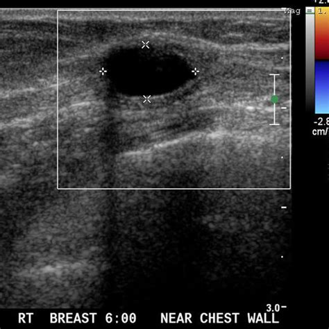 62 Year Old Female With Epidermoid Cyst Of The Breast Mammogram Shows