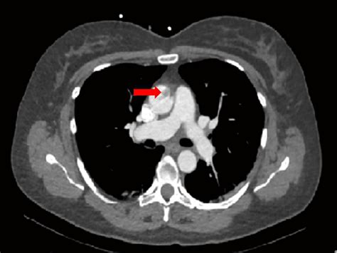 Preoperative Angiographic Computed Tomography Showed A Floating