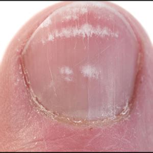 These white spots usually appear on the fingernails or toenails and this condition is called leukonychia, a very common issue that is pretty harmless. Leukonychia (white spots on nails) - Everything You Need ...