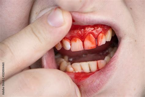 The Man Has Blood On His Teeth Severe Bleeding Of The Gums After A