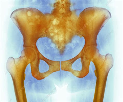Healthy Hip Bones X Ray Stock Image P1160751 Science Photo Library