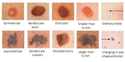 Most skin cancers are caused by exposure to the sun. Skin Cancer 101: A review of the 3 most common skin cancers