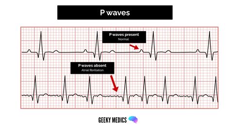P Wave Abnormalities Ecg Ppt