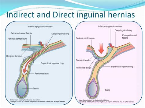 Inguinal Hernia Size Chart