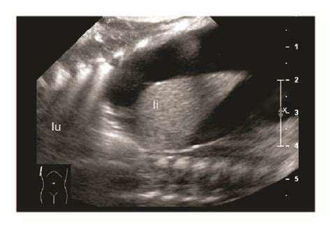 Abdominal Ultrasound Images Showing Massive Ascites A Transverse