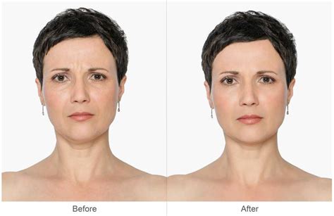 Beauty Tips For Reducing Nasolabial Folds And Marionette Lines The Fuss