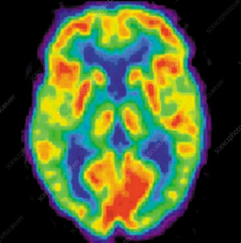 Pet Scan Of A Normal Brain Stock Image C0051680 Science Photo