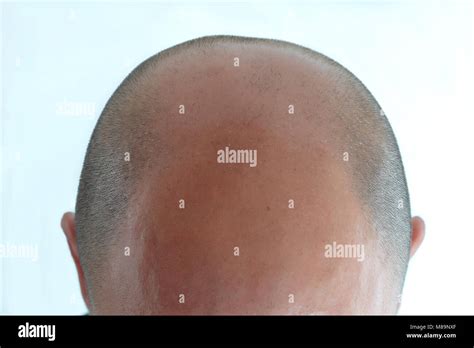 View Of Bald Mans Head With Hair Loss Stock Photo Alamy