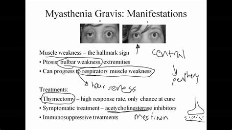 The incidence is 0.5 to 5 cases. Neurologic Pathophysiology: Pain, Myasthenia, and Guillane Barre - YouTube