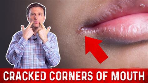 What Causes Cracked Corners Of Mouth And How To Get Rid Of Angular Cheilitis Dr Berg Youtube
