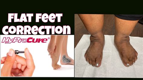 Hyprocure Procedure To Correct Flat Feet Deformity Youtube