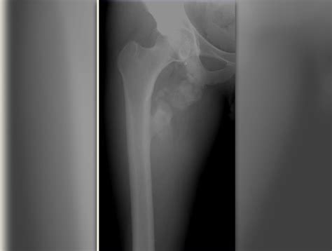 Hip Replacement Complications After Surgery General Center