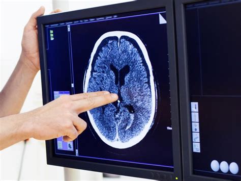 Smaller Brains Earlier Onset Of High Blood Pressure Affects Brain