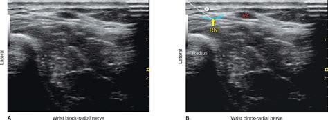 Ultrasound Guided Wrist Block Anesthesia Key