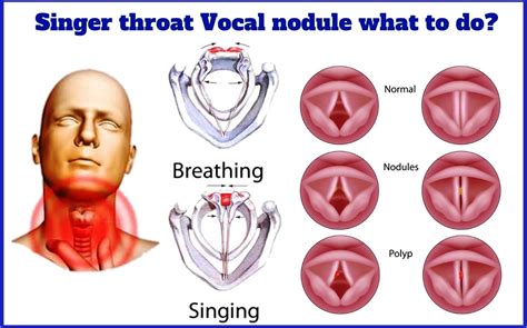 Vocal Nodules And Singers