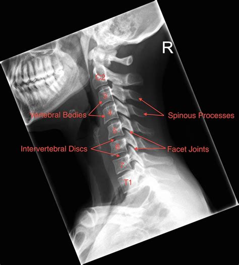 Check Out My Xrays And Tell Me What You Think General Discussion