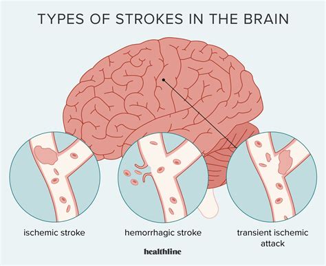 Stroke Symptoms Causes Treatment Types And More