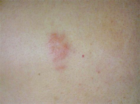 Herpes Pictures And Cold Sores Pictures