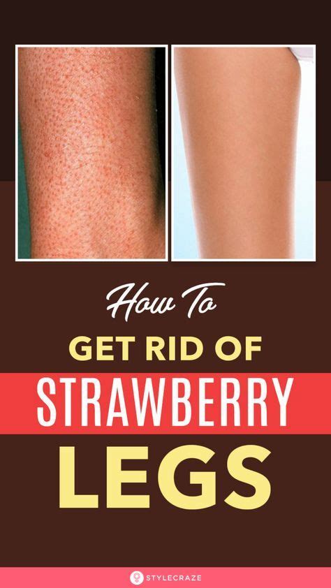 10 Natural Ways To Get Rid Of Strawberry Legs Artofit