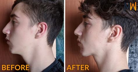 Mewing The Orthodontic Technique That Can Improve Your Jawline
