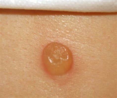 Hobo Spider Bite Pictures Symptoms Stages And Treatment Images And