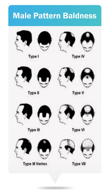 Male Pattern Baldness Symptoms Causes Treatment Prevention RichFeel
