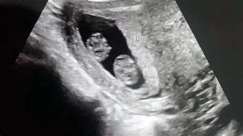 Weeks Pregnant With Twins Symptoms Belly Pictures Ultrasound