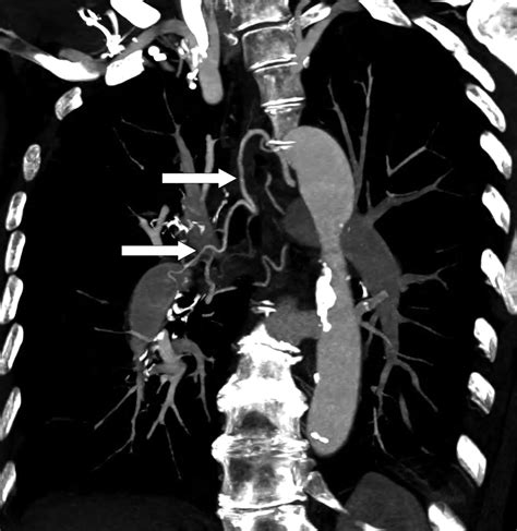 Ebus Tbna In The Differential Diagnosis Of Pulmonary Artery Sarcoma And