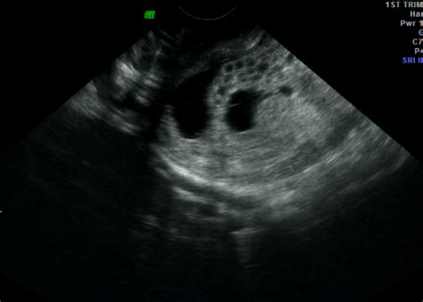 Ultrasound Case Of The Month Hydatidiform Mole — Brown Emergency Medicine