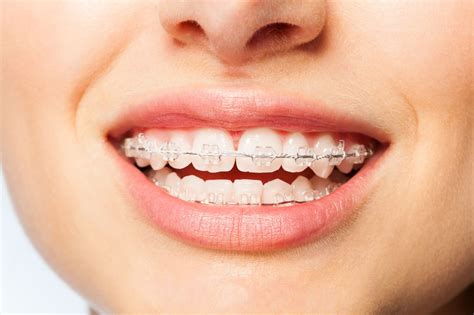 Invisalign Vs Ceramic Braces