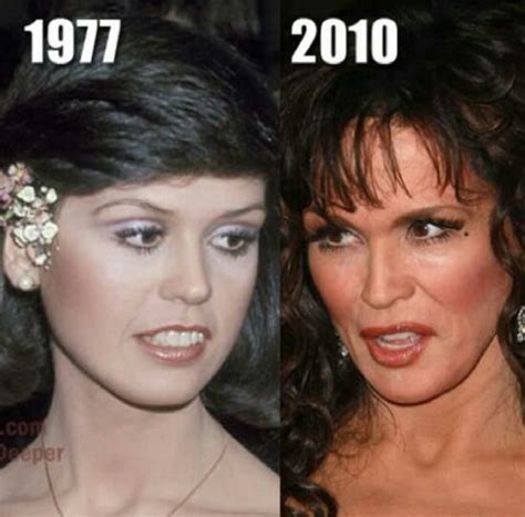 Before And After Plastic Surgery Marie Osmond Celebrity Plastic