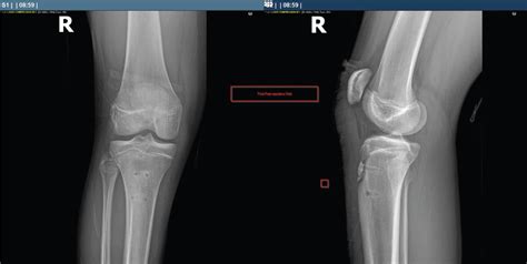 Fastest Recovery Time In Pediatric Tibial Tubercle Avulsion Fracture