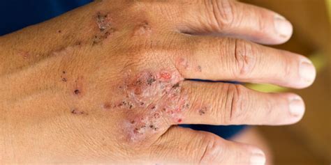 Portland Hand Dermatitis Treatment Norris Dermatology And Laser