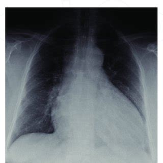 Unter einer myokarditis versteht man eine akute oder chronische entzündung des herzmuskelgewebes. Shows the ECG scan of myocarditis and pericarditis ...