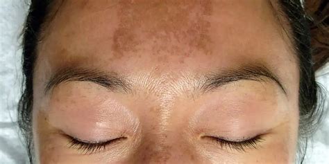 Dark Spots On Face Melasma