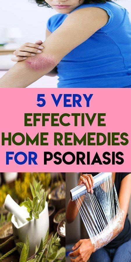 5 Very Effective Home Remedies For Psoriasis Keto Slim Reviews
