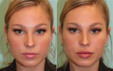 Lip Augmentation Photos Chevy Chase Md Patient