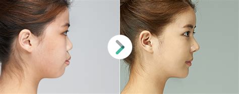 Both chin implants and sliding genioplasty, which involves cutting and reshaping your lower jaw bone, can help. Chin correction surgery is a great way to improve your ...