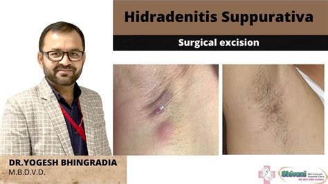 Hidradenitis Suppurativa Surgical Excision Dr Yogesh Bhingradia