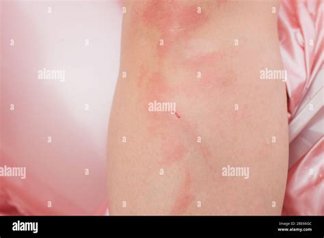 Dermatite Herpétiforme Banque De Photographies Et Dimages à Haute