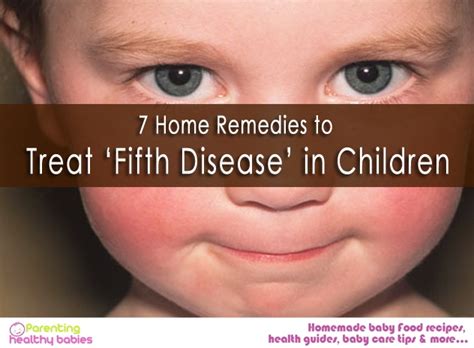 7 Home Remedies To Treat ‘fifth Disease In Children