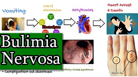 Bulimia Nervosa Uncontrolled Eating Emotional Eating Youtube