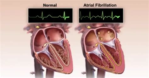 7 warning signs of an irregular heartbeat and 5 ways to correct it