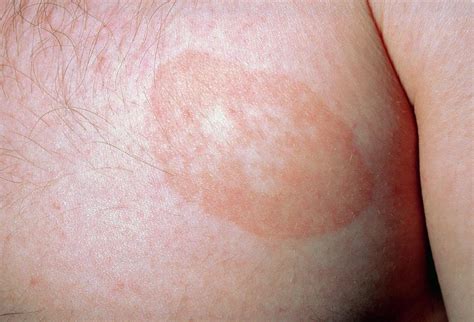 Tinea Corporis Photograph By Dr P Marazzi Science Photo Library